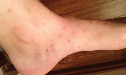 flea bites on human foot