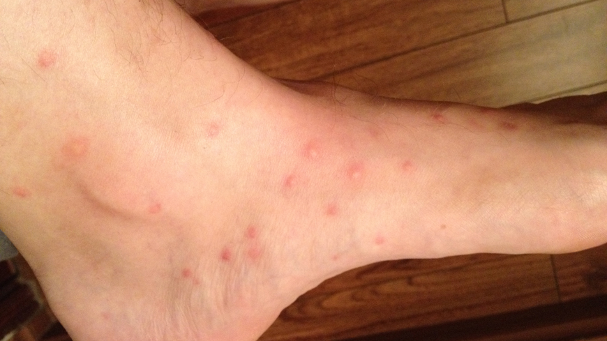 Do Fleas Bite In Clusters Of Three FleaScience